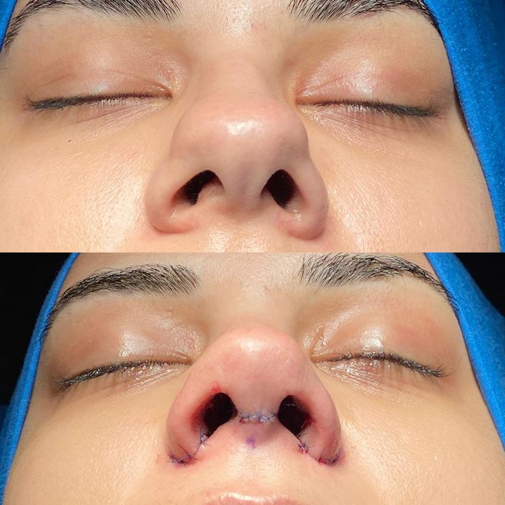 انواع عمل بینی گوشتی