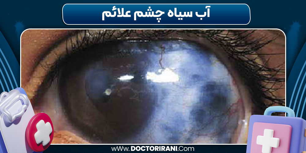 آب سیاه چشم علائم