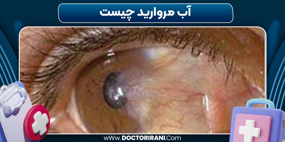 آب مروارید چیست آب مروارید چیست