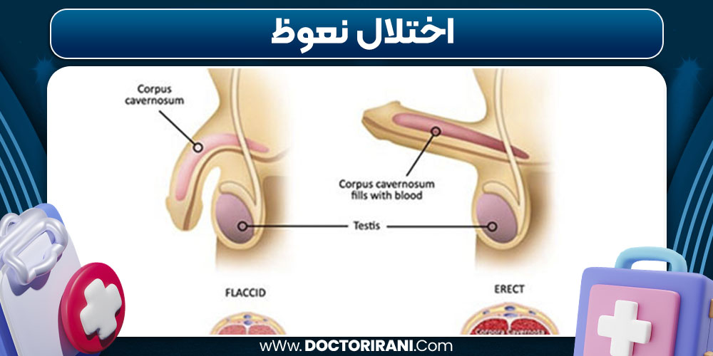 اختلال نعوظ در مردان