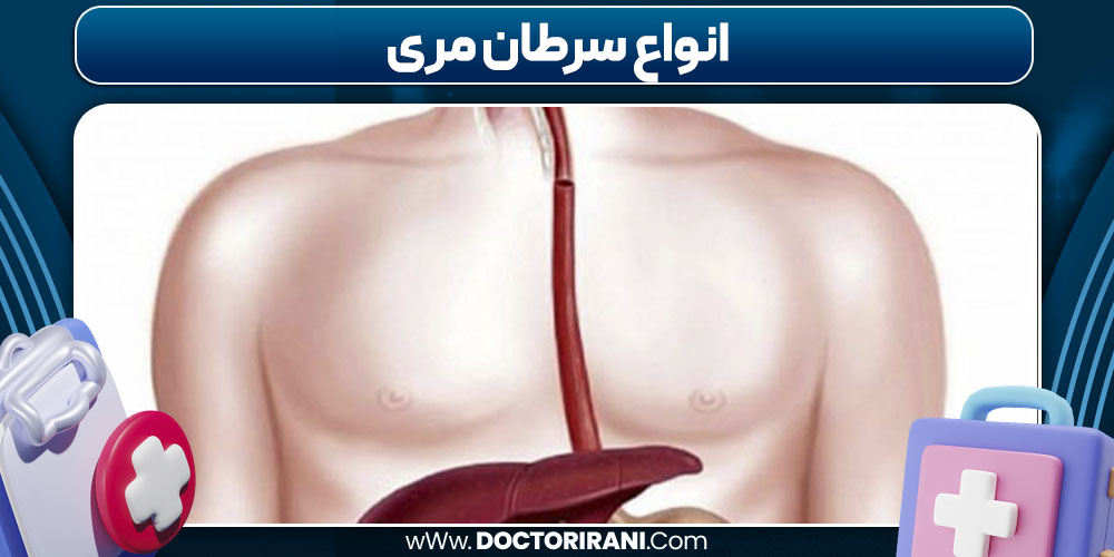 انواع سرطان مری