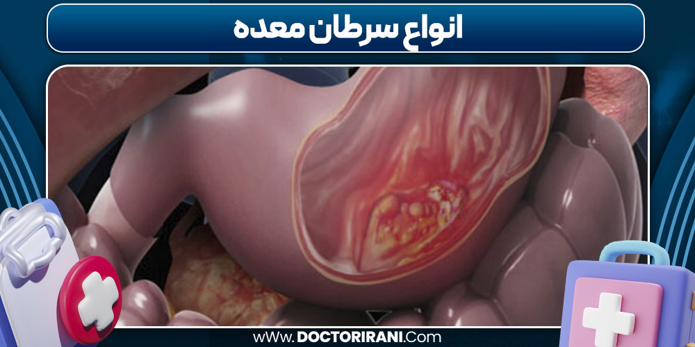 انواع سرطان معده