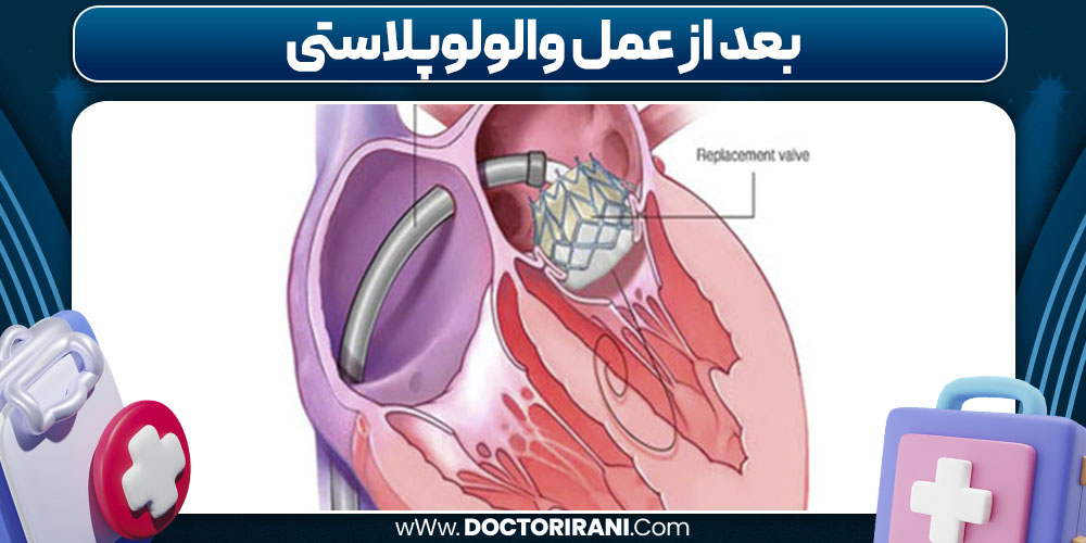 بعد از عمل والولوپلاستی
