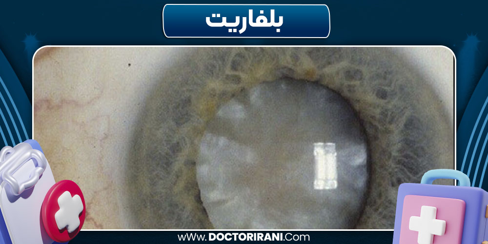 بلفاریت
