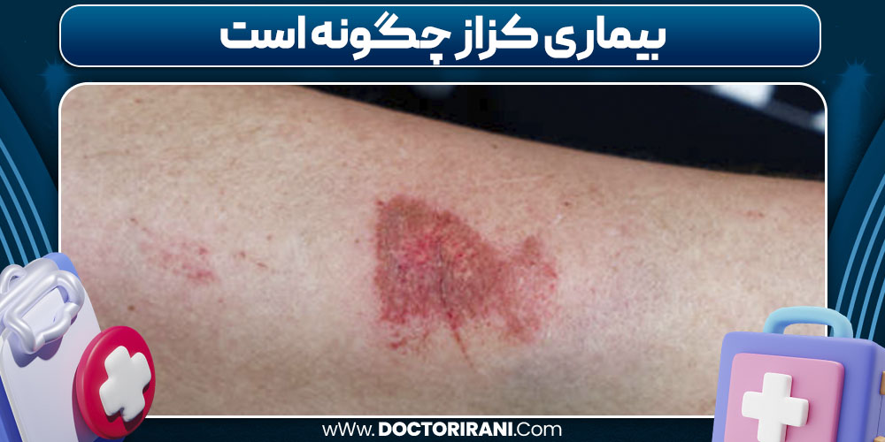 بیماری کزاز چگونه است