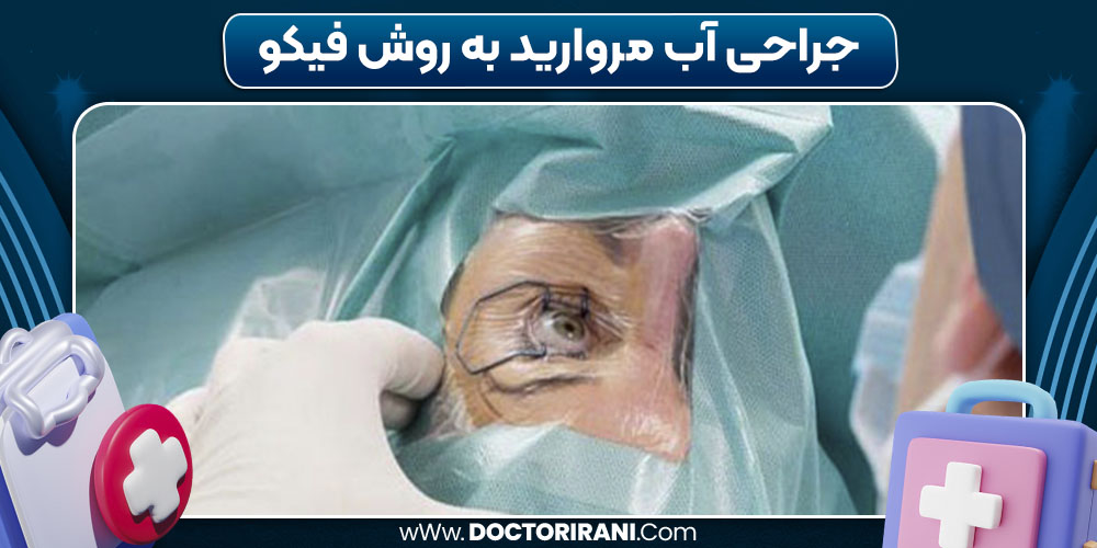 عمل آب مروارید به روش فیکو