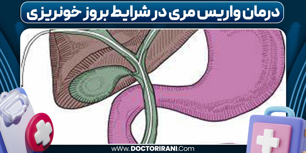 درمان واریس مری در شرایط بروز خونریزی
