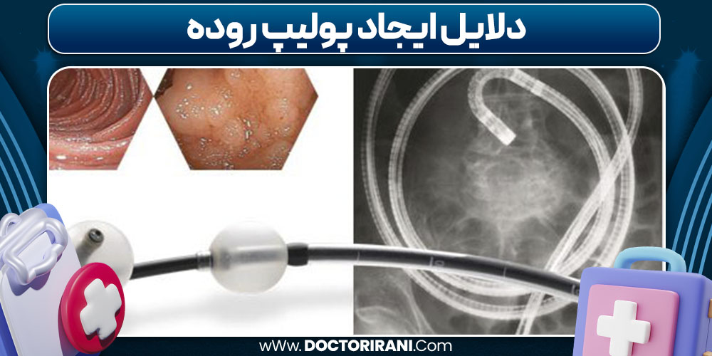دلایل ایجاد پولیپ روده