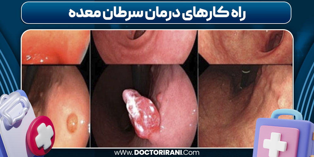راه کارهای درمان سرطان معده