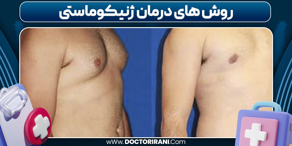 روش های درمان ژنیکوماستی