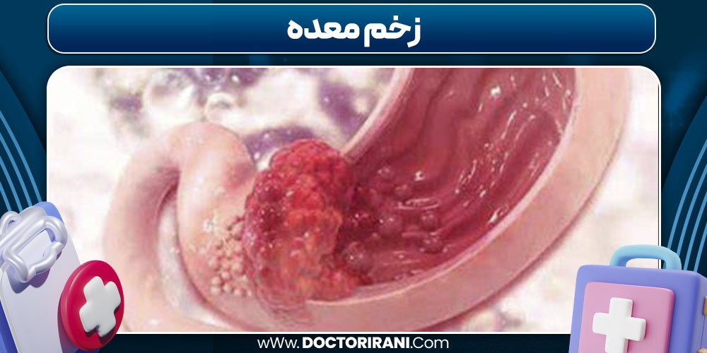 زخم معده