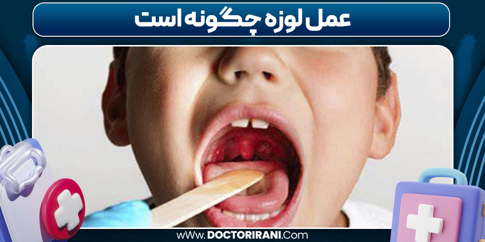 عمل لوزه چگونه است