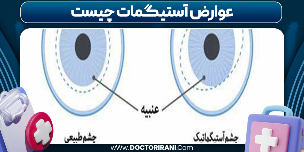 عوارض آستیگمات چیست