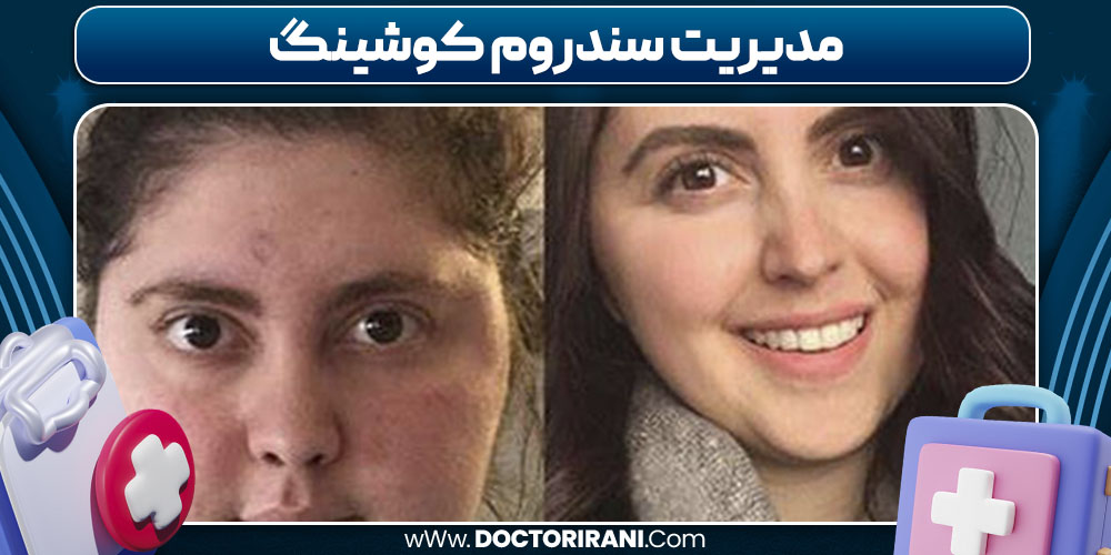 مدیریت سندروم کوشینگ