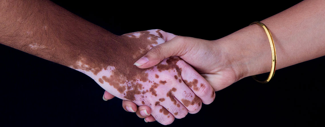 عوارض بیماری پیسی