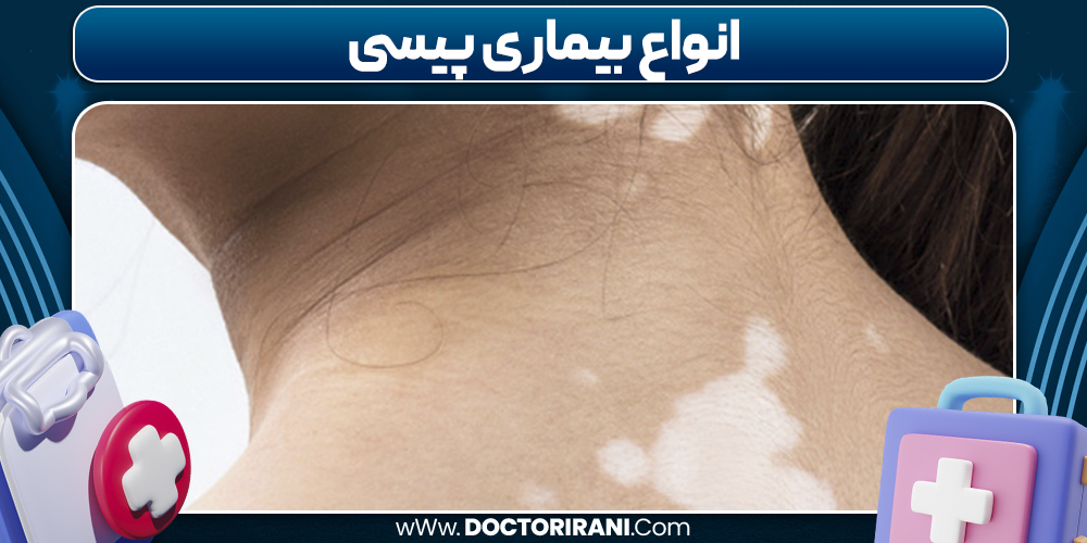 انواع بیماری پیسی