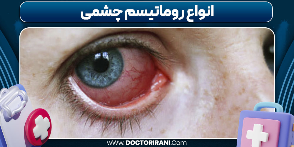 انواع روماتیسم چشمی
