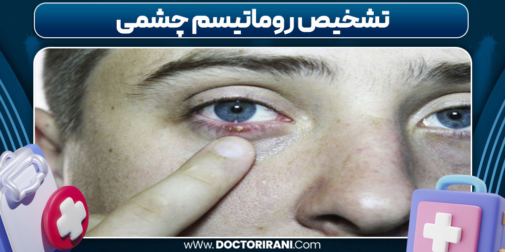 تشخیص روماتیسم چشمی