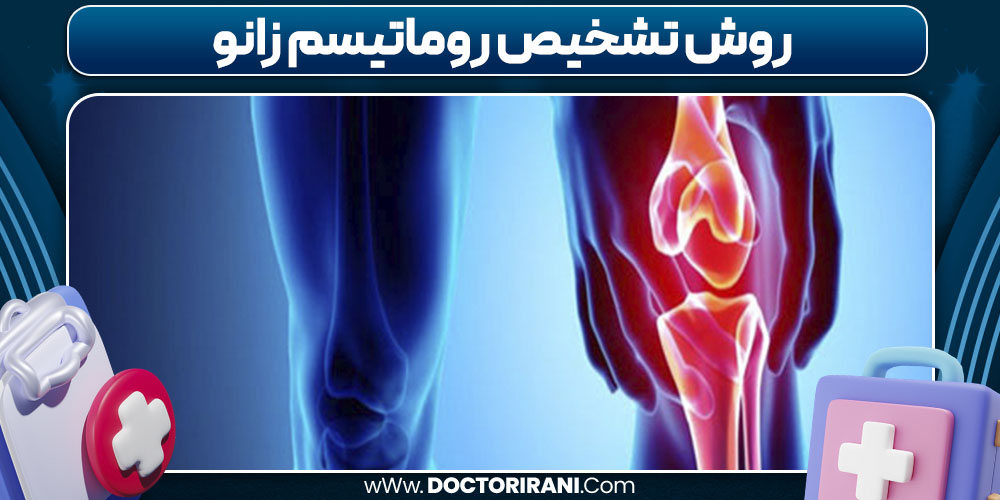 روش تشخیص روماتیسم زانو روش تشخیص روماتیسم زانو