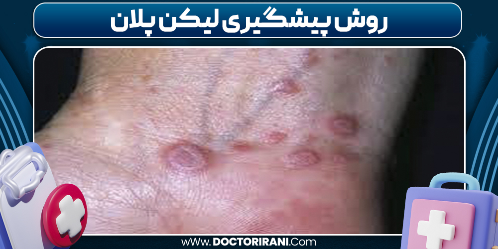 روش پیشگیری لیکن پلان