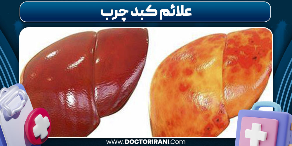علائم کبد چرب