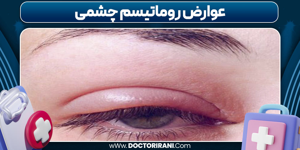 عوارض روماتیسم چشمی