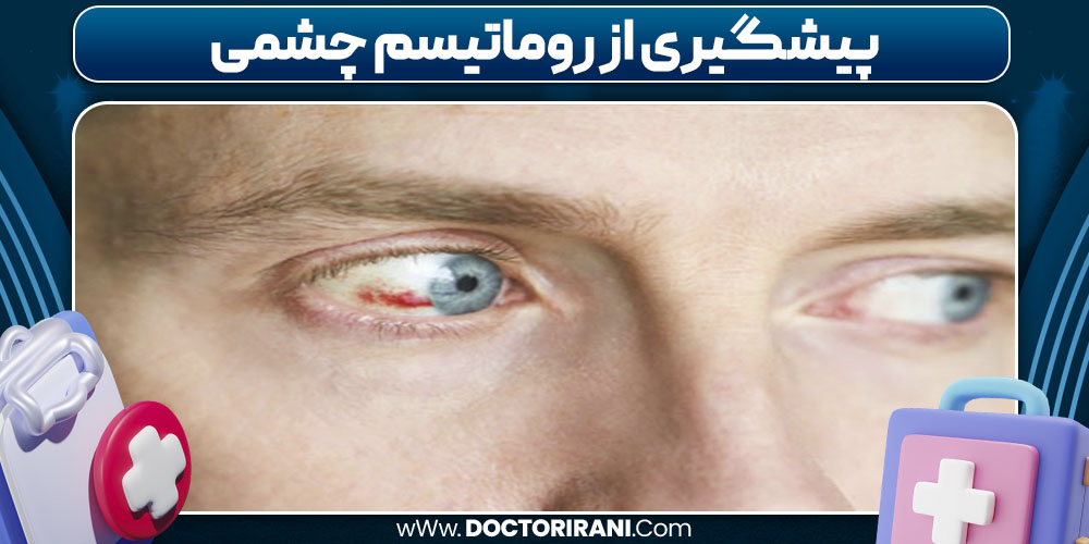 پیشگیری از روماتیسم چشمی