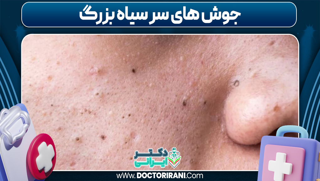جوش های سر سیاه بزرگ