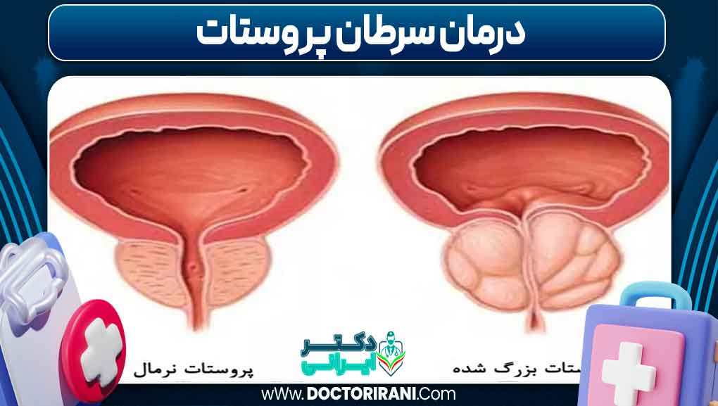 درمان سرطان پروستات