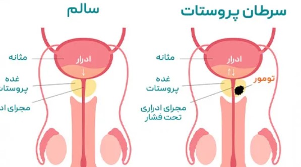 سرطان پروستات باعث مرگ می‌شود