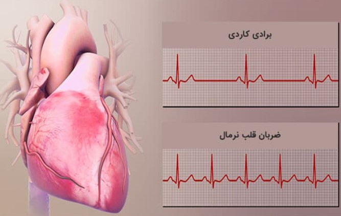 جراحی آریتمی قلبی