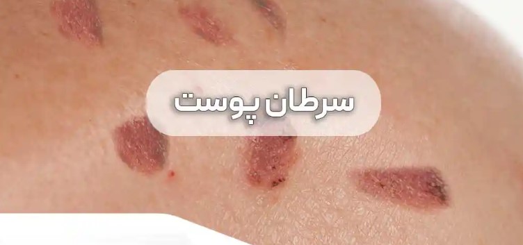 عمل سرطان پوست