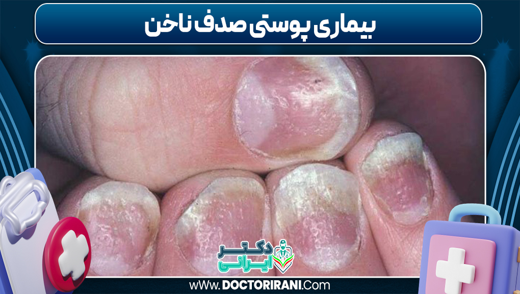بیماری پوستی صدف ناخن