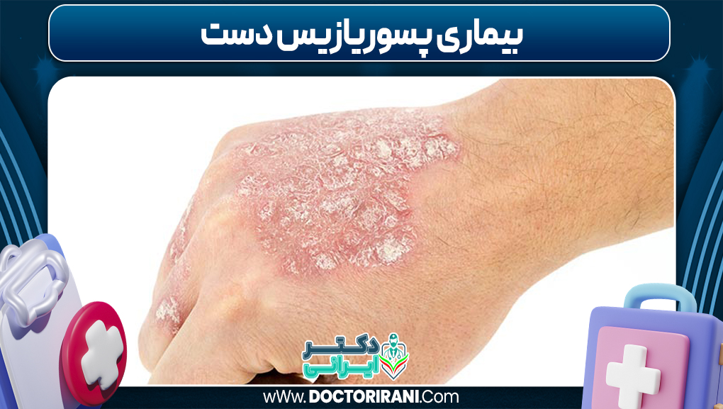 عکس بیماری پسوریازیس دست