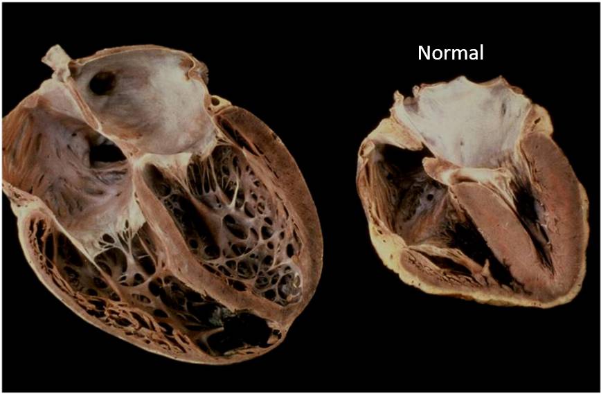 انواع کاردیومیوپاتی