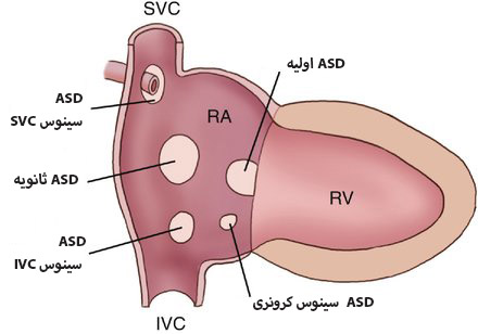 انواع VSD انواع VSD