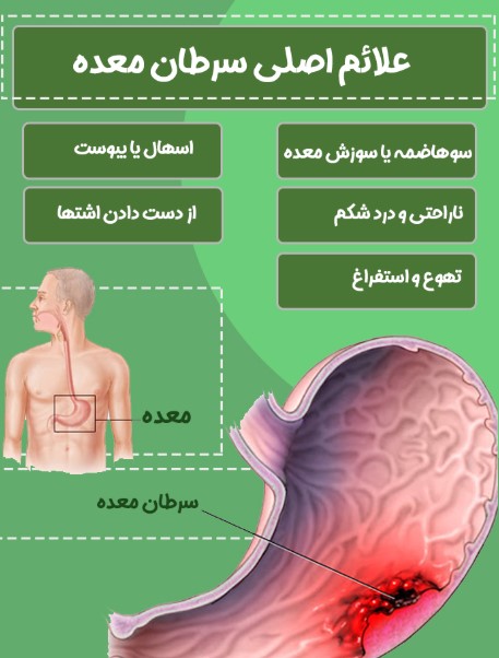 علائم اولیه سرطان معده