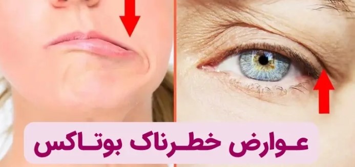 عوارض بوتاکس در شیردهی