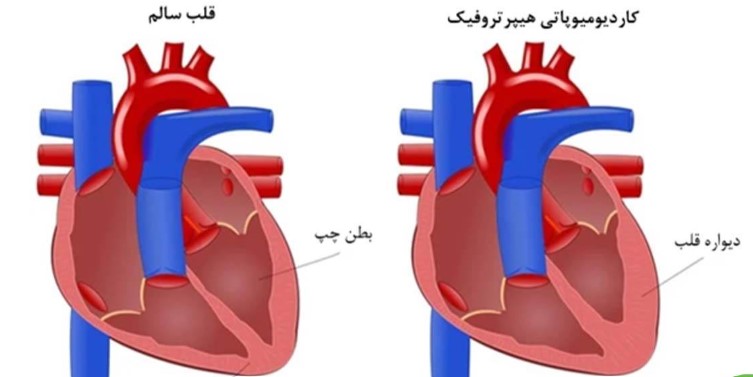 کاردیومیوپاتی اتساعی
