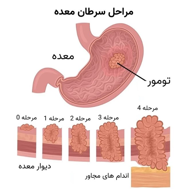 جراحی سرطان معده
