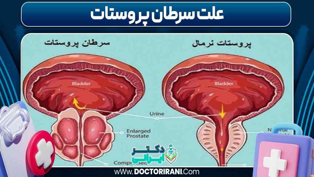 علت سرطان پروستات