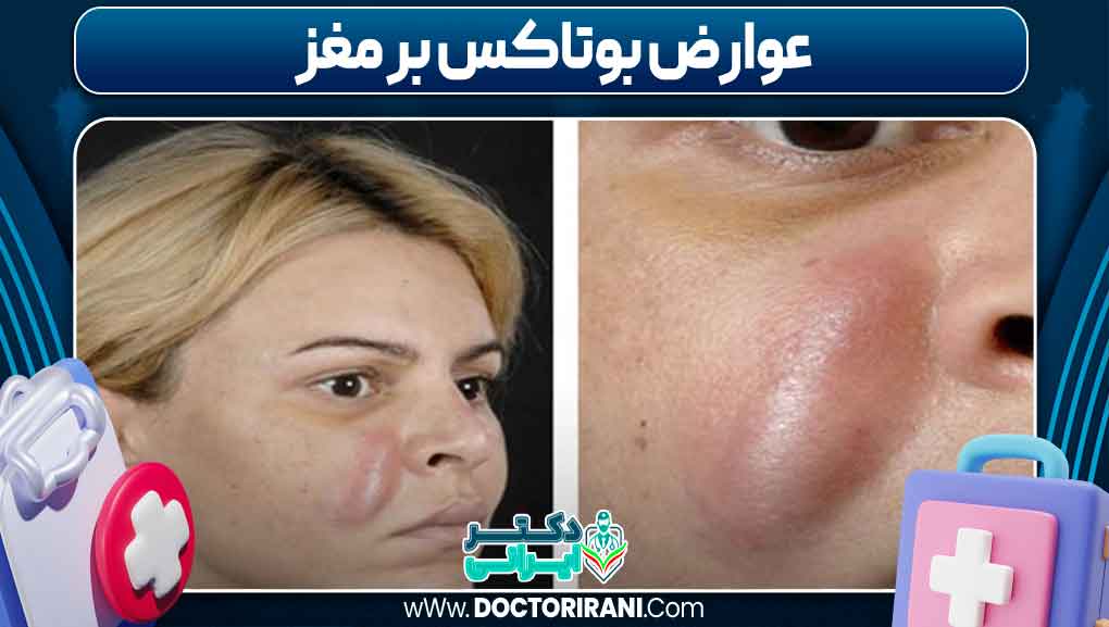 عوارض بوتاکس بر مغز