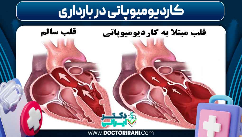 کاردیومیوپاتی در بارداری