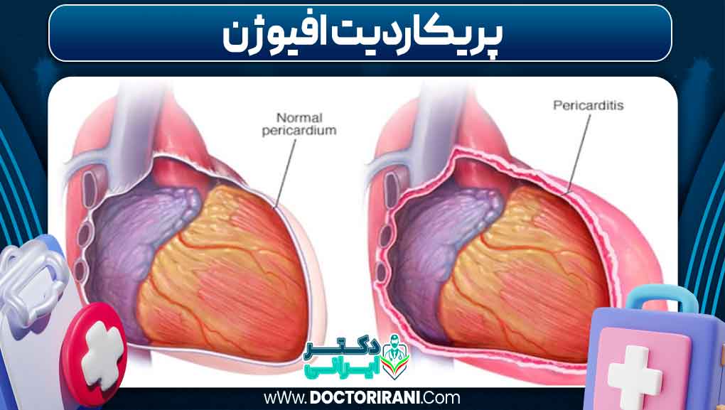پریکاردیت افیوژن
