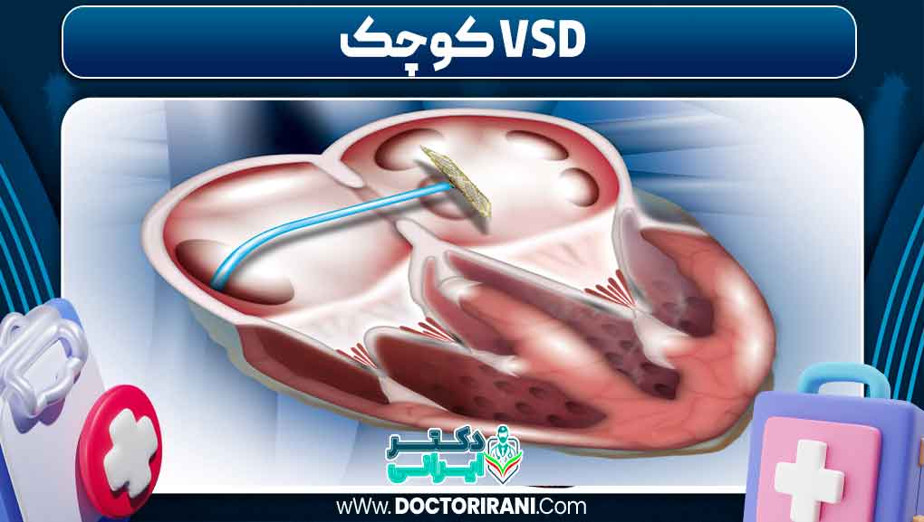 VSD کوچک VSD کوچک