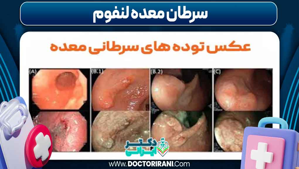 سرطان معده لنفوم