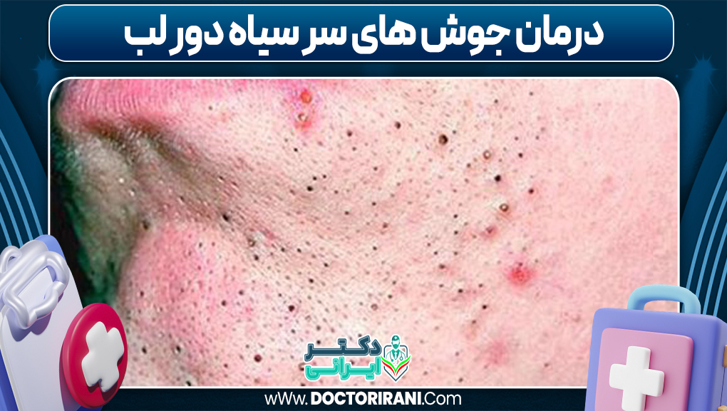 درمان جوش های سر سیاه دور لب