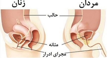 پیشگیری از سنگ مثانه
