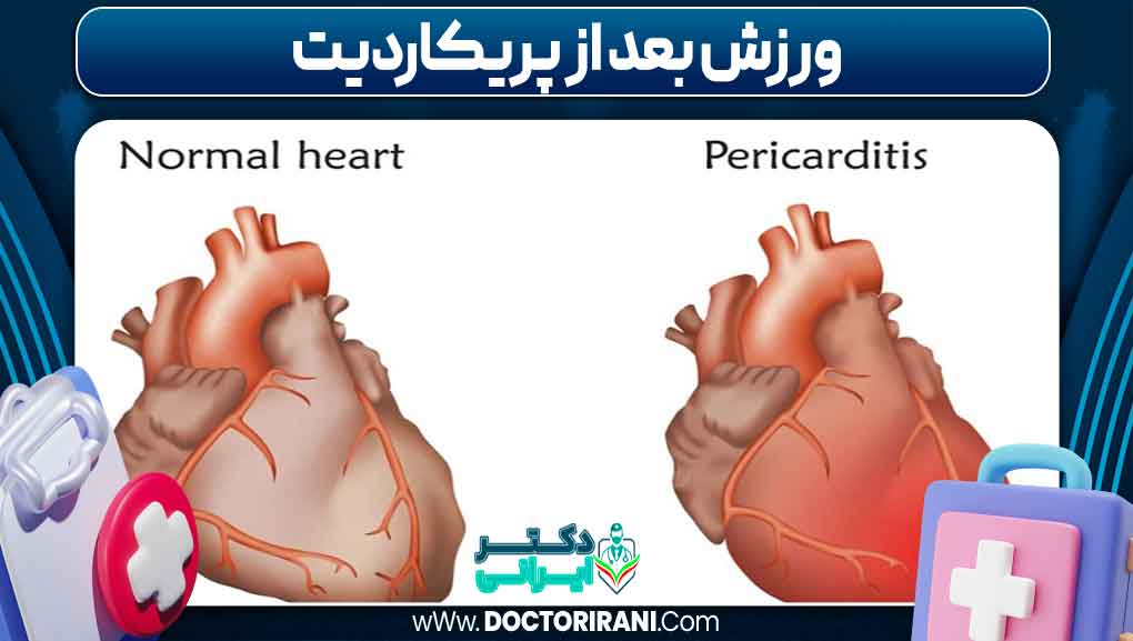 ورزش بعد از پریکاردیت