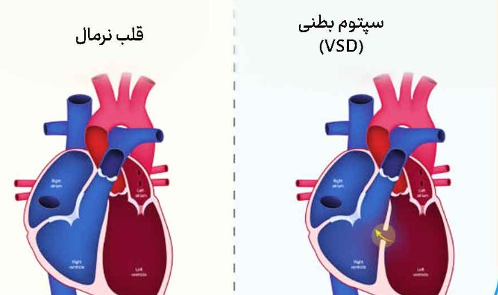 VSD و فشار خون ریوی VSD و فشار خون ریوی